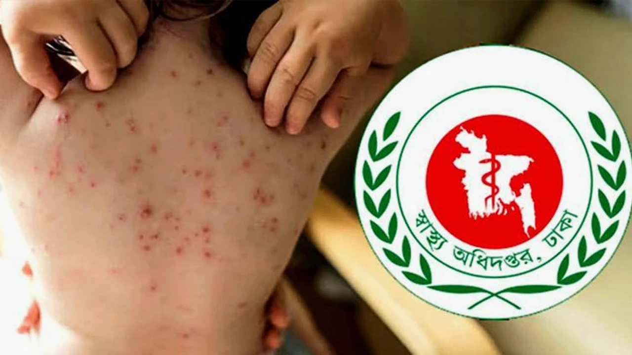 ময়মনসিংহে হামের উপসর্গ নিয়ে ২ শিশুর মৃত্যু